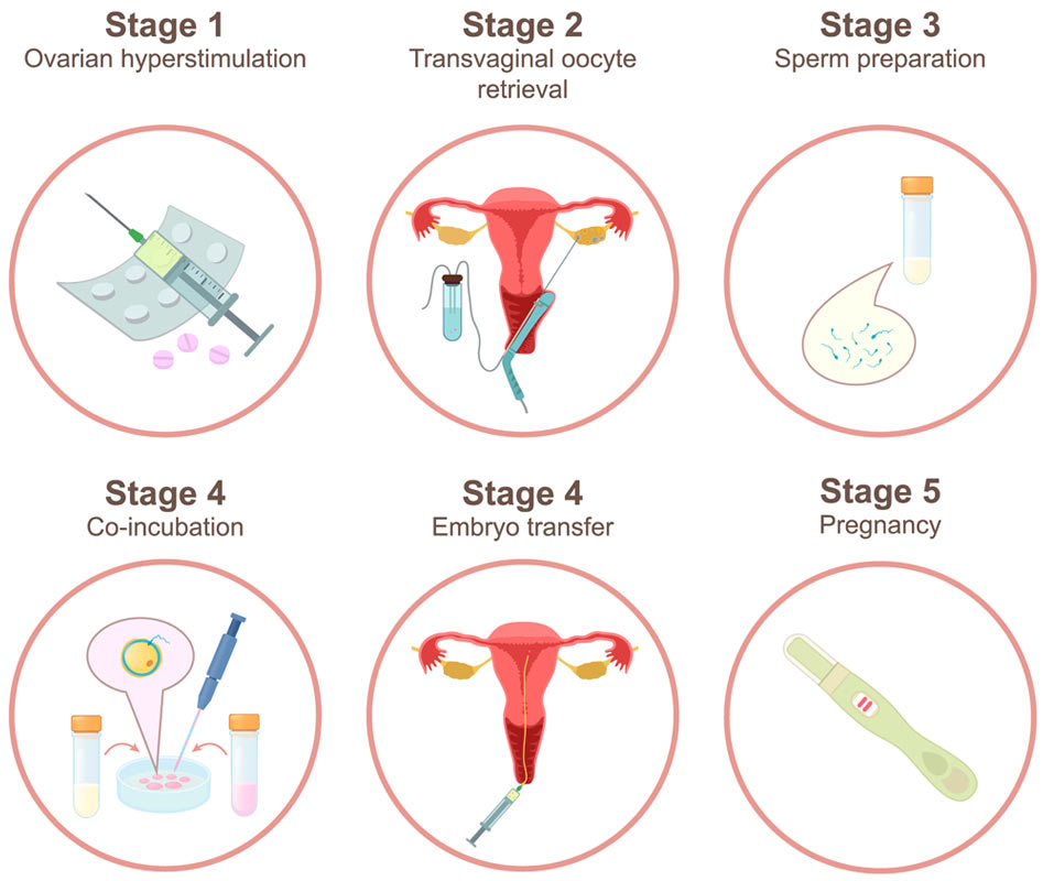 6-Stage Egg Donation Clinical Flowchart from Ovarian Stimulation to Pregnancy Confirmation